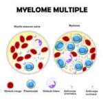 Myélome Multiple : Compréhension d’une Maladie Complexefère
