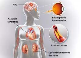 Lire la suite à propos de l’article Hypertension Artérielle : Comprendre, Prévenir et Gérer