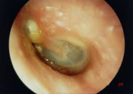 Lire la suite à propos de l’article Otite : Comprendre cette infection de l’oreille et comment la traiter efficacement