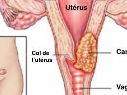 Cancer de l'utérus tisane efficace