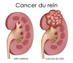 You are currently viewing Cancer du Rein : Comprendre, Causes, Symptômes, Diagnostic et Traitements