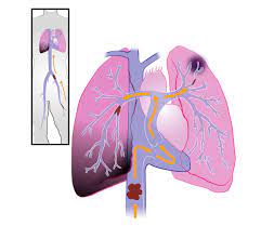 You are currently viewing Embolie Pulmonaire : Causes, Symptômes, Diagnostic et Traitements