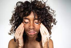 Lire la suite à propos de l’article Vitiligo : Causes, Symptômes, Traitement et Gestion