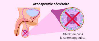 Lire la suite à propos de l’article L’Azoospermie : Comprendre l’Absence de Spermatozoïdes dans le Sperme