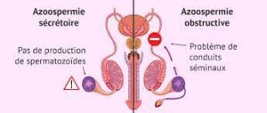 Lire la suite à propos de l’article Azoospermie : Comprendre l’Absence de Spermatozoïdes dans le Sperme