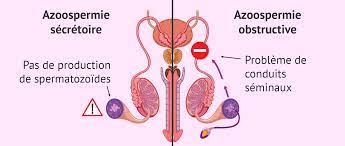 You are currently viewing Azoospermie : Comprendre l’Absence de Spermatozoïdes dans le Sperme