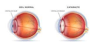 Lire la suite à propos de l’article Cataracte : Comprendre l’Obscurcissement du Cristallin Oculaire