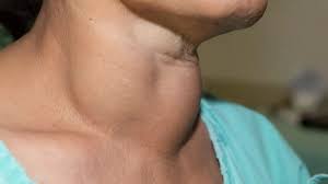 Lire la suite à propos de l’article Goitre : Un Agrandissement Anormal de la Glande Thyroïde