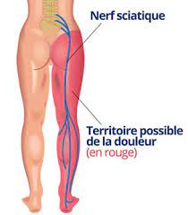You are currently viewing Hernie Sciatique : Une Compression Nerveuse Douloureuse