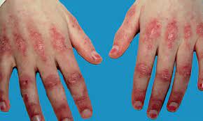 Lire la suite à propos de l’article Dermatomyosite : Une Maladie Auto-immune Affectant la Peau et les Muscles