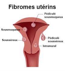 Lire la suite à propos de l’article Fibrome Utérin : Comprendre une Condition Commune chez les Femmes
