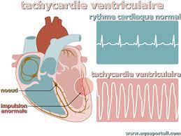You are currently viewing Tachycardie : Comprendre, Causes, Symptômes, Diagnostic et Traitement